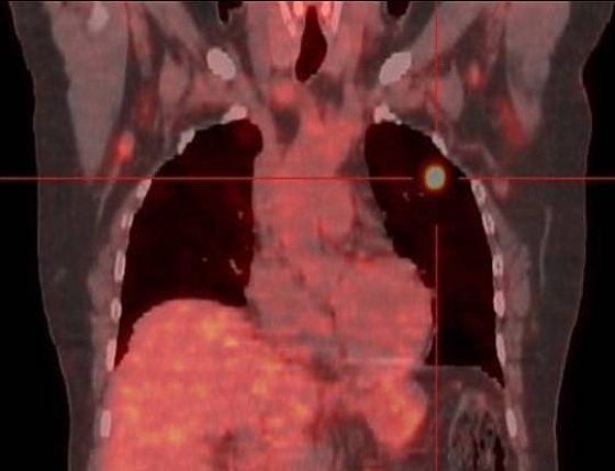 PET bilde av pasient (Bredde: 560px)