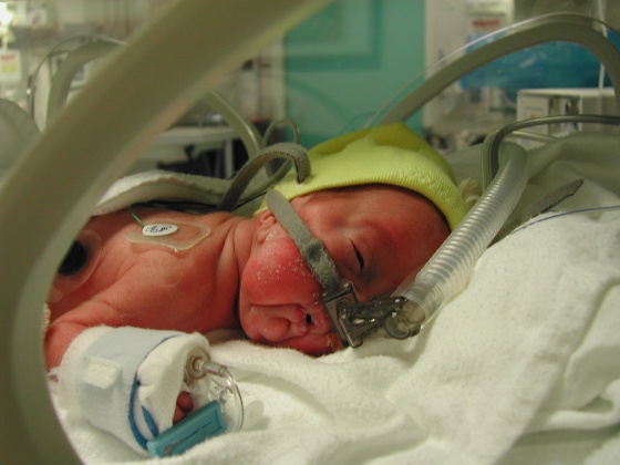 prematur baby.jpg (Bredde: 560px)