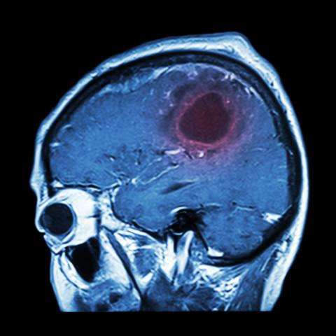 Røntgen av hjerne med kreft