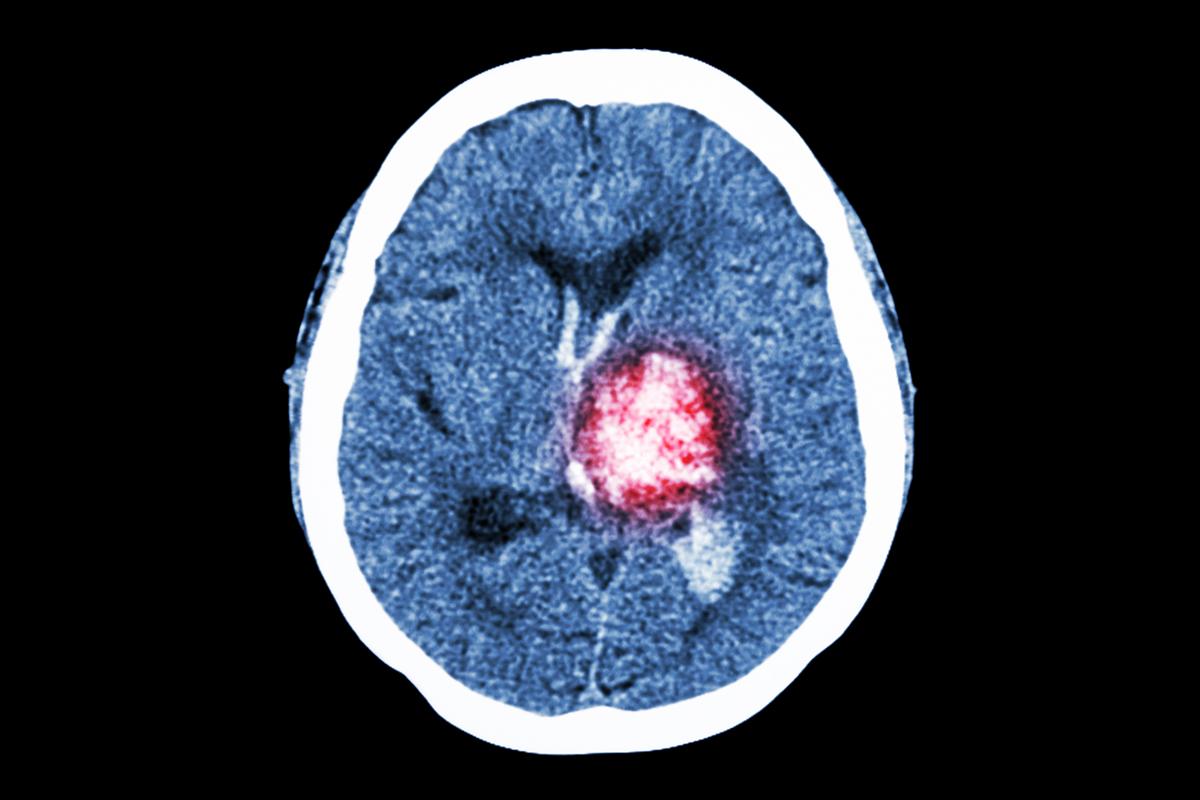 CT av en hjerneblødning 