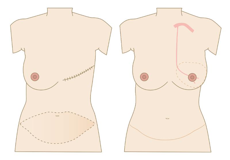 50% OFF Sexy Stoma High Waist Body Shaper-Stoma Ostomy Tummy