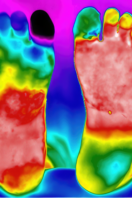 Thermography cold injury vertical.png