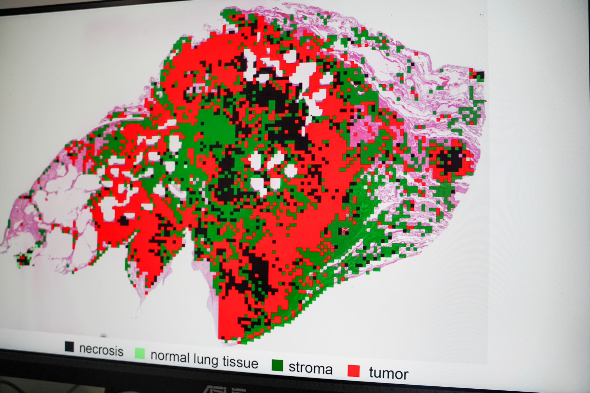 Bildet viser hvordan systemet skiller mellom friskt, sykt og dødt lungevev på et digitalisert snittbilde.