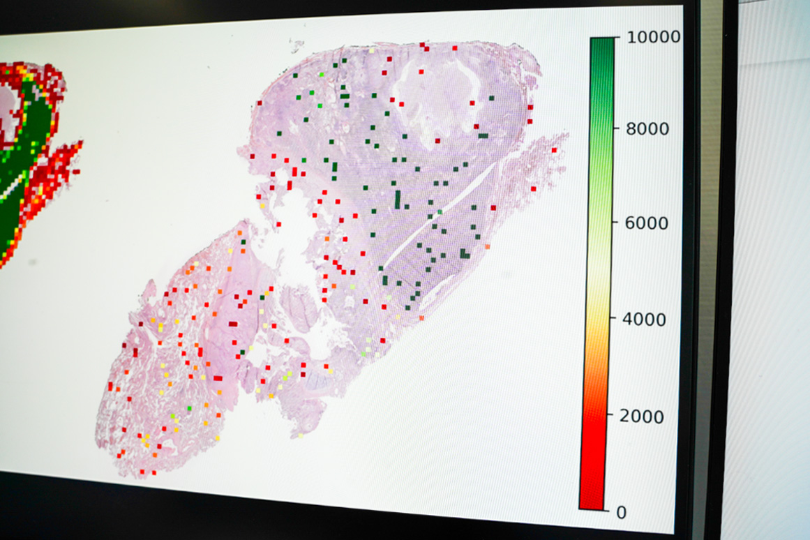 Bildet viser hvordan KI-systemet har markert små tilfeldige deler av snittbildet med tumor-infiltrerende lymfocytter.