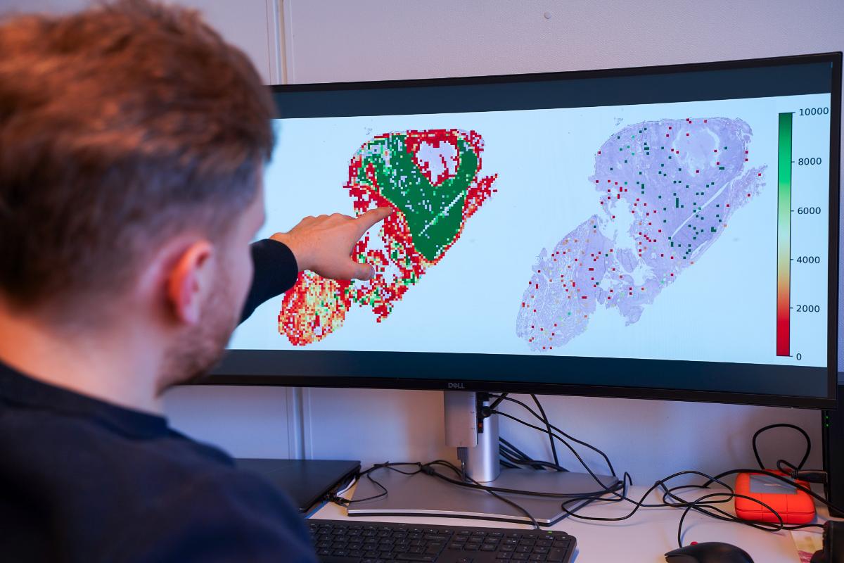 En mann sitter foran en datamaskin med bilder av en lungekreftsvulst.